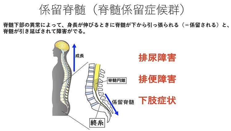 脊髄係留症候群